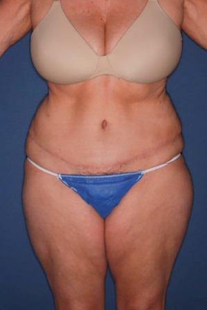 Abdominoplasty 1 postop - Copy Abdominoplasty 1 postop - Copy