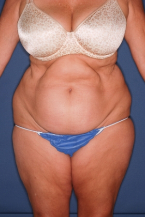 Abdominoplasty 1 preop Abdominoplasty 1 preop