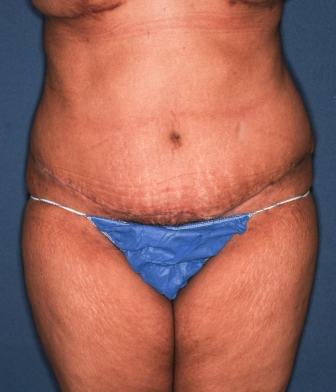 Abdominoplasty 10 postop, 2 mo postop Abdominoplasty 10 postop, 2 mo postop