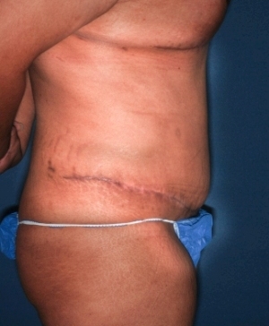 Abdominoplasty 10 postop lateteral Abdominoplasty 10 postop lateteral