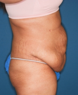 Abdominoplasty 10 preop lateral Abdominoplasty 10 preop lateral