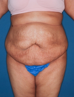 Abdominoplasty 10 preop Abdominoplasty 10 preop