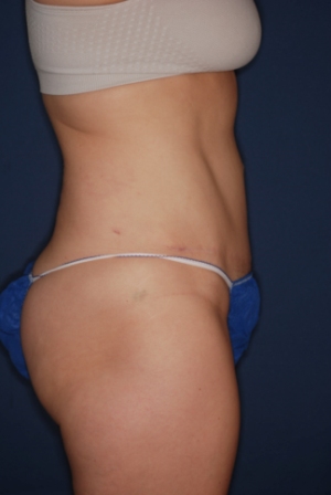 Abdominoplasty 2 postop lateral Abdominoplasty 2 postop lateral