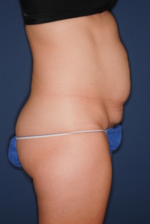 Abdominoplasty 2 preop lateral Abdominoplasty 2 preop lateral