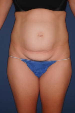 Abdominoplasty 2 preop Abdominoplasty 2 preop