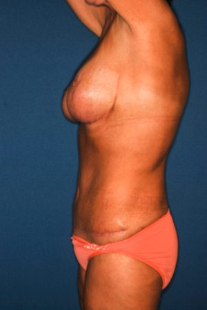 Abdominoplasty 3 postop lateral, combined procedure 1 Abdominoplasty 3 preop lateral, combined procedure one preop