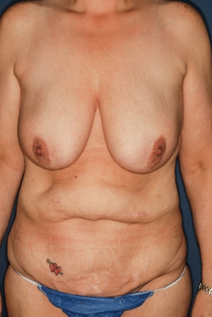 Abdominoplasty 3 preop, combined procedure 1 preop Abdominoplasty 3 preop, combined procedure 1 preop