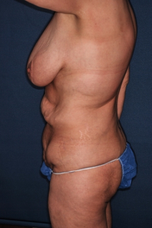 Abdominoplasty 3 preop lateral, combined procedure one preop Abdominoplasty 3 preop lateral, combined procedure one preop