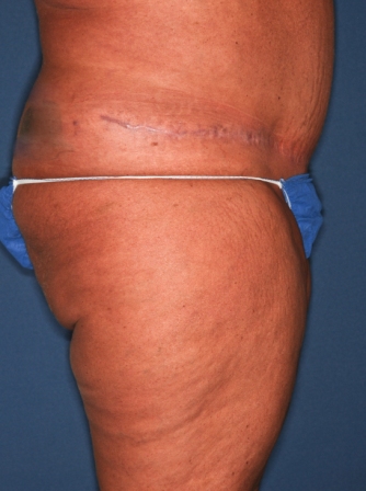 Abdominoplasty 4 postop lateral Abdominoplasty 4 postop lateral