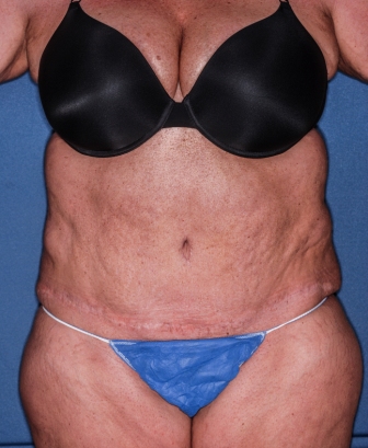 Abdominoplasty 4 postop Abdominoplasty 4 postop
