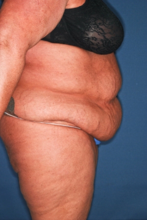 Abdominoplasty 4 preop lateral Abdominoplasty 4 preop lateral