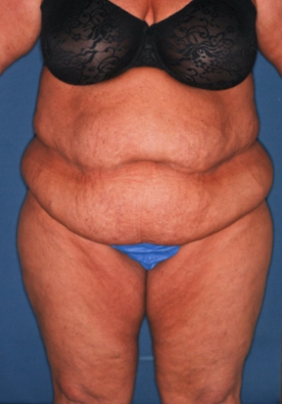 Abdominoplasty 4 preop Abdominoplasty 4 preop