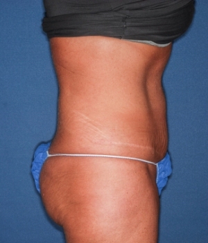 Abdominoplasty 5 postop lateral Abdominoplasty 5 postop lateral