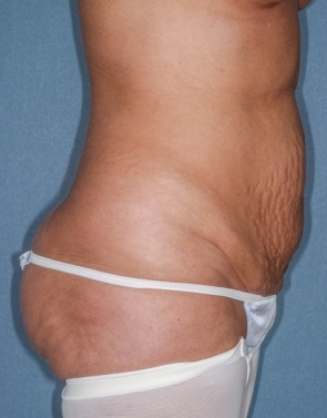 Abdominoplasty 5 preop lateral