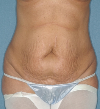 Abdominoplasty 5 preop Abdominoplasty 5 preop