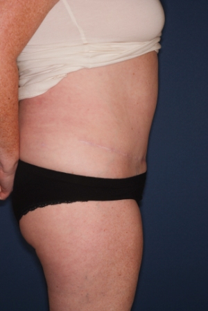 Abdominoplasty 6 postop lateral Abdominoplasty 6 postop lateral