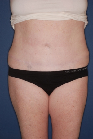 Abdominoplasty 6 postop Abdominoplasty 6 postop