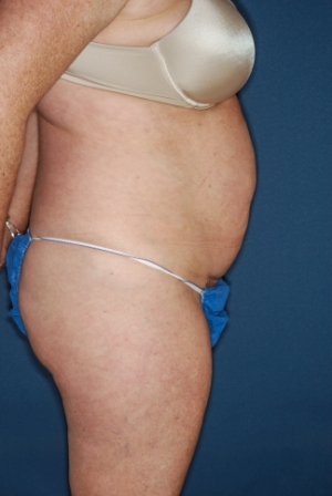 Abdominoplasty 6 preop lateral Abdominoplasty 6 preop lateral