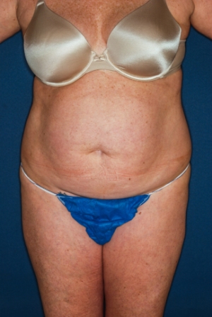 Abdominoplasty 6 preop Abdominoplasty 6 preop