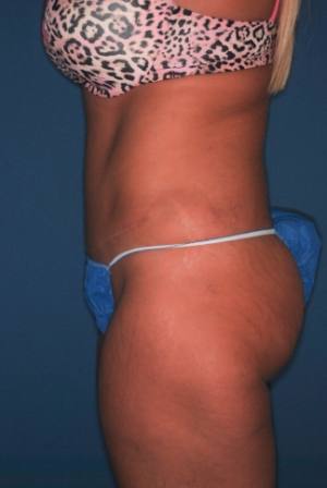 Abdominoplasty 7 postop lateral Abdominoplasty 7 postop lateral