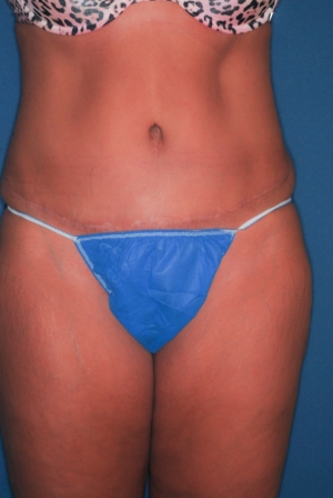 Abdominoplasty 7 postop Abdominoplasty 7 postop