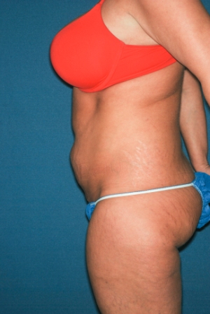 Abdominoplasty 7 preop lateral Abdominoplasty 7 preop lateral
