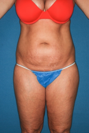 Abdominoplasty 7 preop Abdominoplasty 7 preop