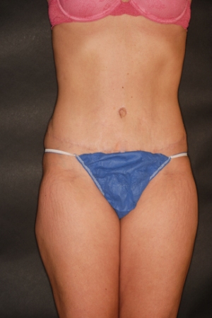 Abdominoplasty 8 postop Abdominoplasty 8 postop
