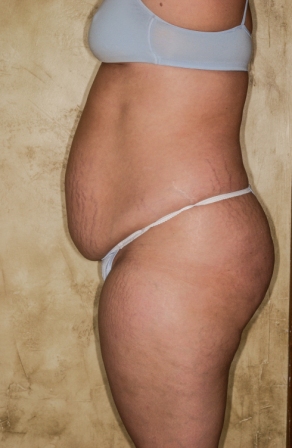 Abdominoplasty 8 preop lateral Abdominoplasty 8 preop lateral