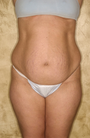 Abdominoplasty 8 preop Abdominoplasty 8 preop