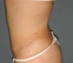 Abdominoplasty 9 postop lateral Abdominoplasty 9 postop lateral