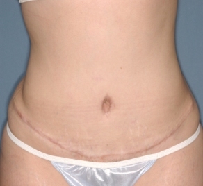Abdominoplasty 9 postop Abdominoplasty 9 postop
