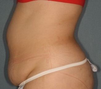 Abdominoplasty 9 preop lateral Abdominoplasty 9 preop lateral