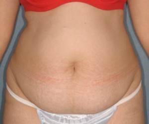 Abdominoplasty 9 preop Abdominoplasty 9 preop