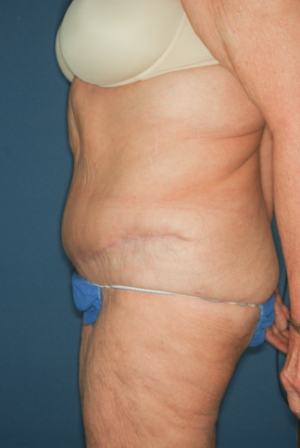 Abdominoplasty Massive weight loss 1 postop lateral Abdominoplasty Massive weight loss 1 postop lateral