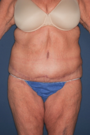 Abdominoplasty Massive weight loss 1 postop Abdominoplasty Massive weight loss 1 postop