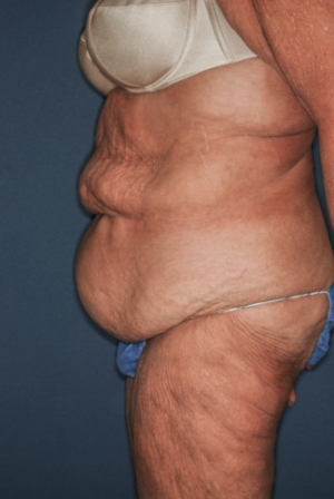 Abdominoplasty Massive weight loss 1 preop lateral Abdominoplasty Massive weight loss 1 preop lateral