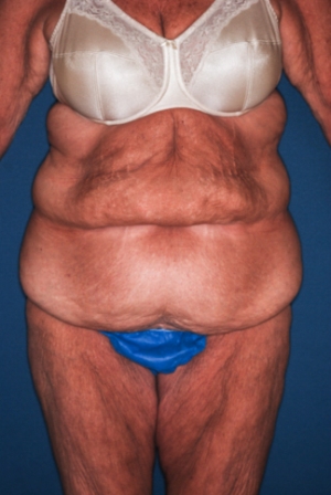 Abdominoplasty Massive weight loss 1 preop Abdominoplasty Massive weight loss 1 preop
