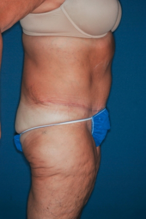 Abdominoplasty Massive weight loss 2, postop lateral Abdominoplasty Massive weight loss 2, postop lateral