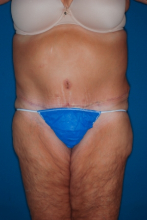 Abdominoplasty Massive weight loss 2 postop Abdominoplasty Massive weight loss 2 postop