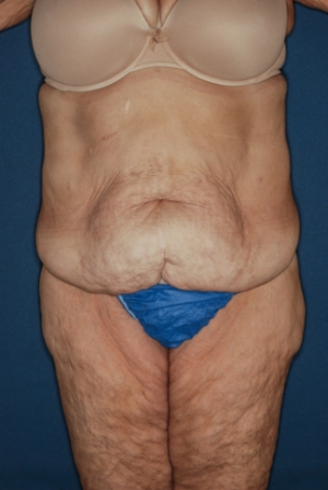 Abdominoplasty Massive weight loss 2 preop Abdominoplasty Massive weight loss 2 preop