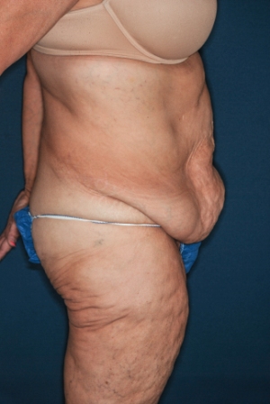 Abdominoplasty Massive weight loss 2 prop lateral Abdominoplasty Massive weight loss 2 prop lateral
