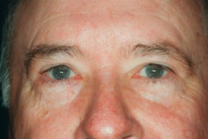 Blepharoplasty upper 1 postop Blepharoplasty upper 1 postop