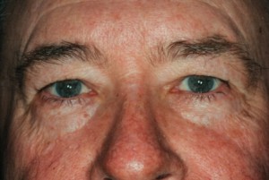 Blepharoplasty, upper 1 preop Blepharoplasty, upper 1 preop