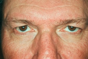 Blepharoplasty, upper 2 preop Blepharoplasty, upper 2 preop