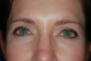 Blepharoplasty upper 3 postop Blepharoplasty upper 3 postop