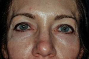 Blepharoplasty, upper 3 preop Blepharoplasty, upper 3 preop
