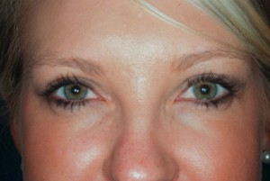 Blepharoplasty, upper 4 postop Blepharoplasty, upper 4 postop