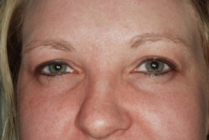 Blepharoplasty upper 4 preop Blepharoplasty upper 4 preop