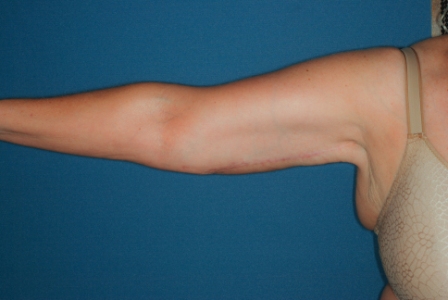 Brachioplasty 1 postop Brachioplasty 1 postop